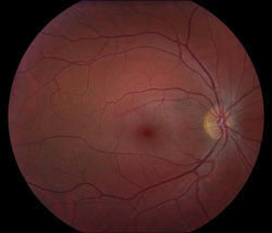 Fundus photography