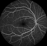 Fluorescein Angiography