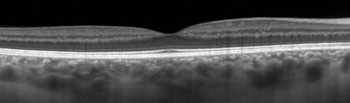 A normal Optical coherence tomography